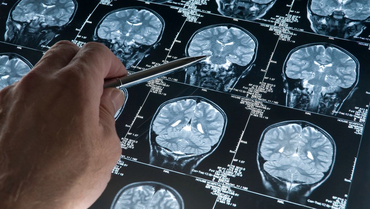 Deneysel Alzheimer ilacı bilişsel gerilemeyi yavaşlattı